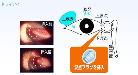 目の腫れを軽減するための家庭療法